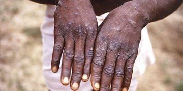 Santé : plus de 90 personnes touchées par la variole de singe