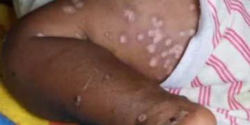 L&rsquo;Épidémie Monkeypox signalée dans 22 des 26 provinces RDC.