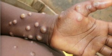 Un plan de réponse RDC pour la maladie Monkeypox est attendu ce mardi 27 février
