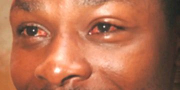 Lomami : Près de 60 cas de conjonctivite  enregistrés durant les deux derniers mois à la prison centrale de Mwene-Ditu